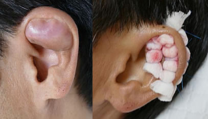 耳介血腫
